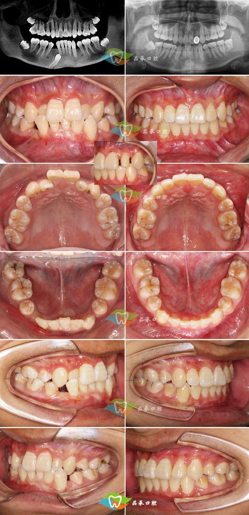 军医大口腔医院成人正畸-图2 军医大口腔医院成人正畸-图2