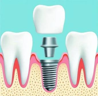 诺贝尔active种牙技术好在哪？-图3