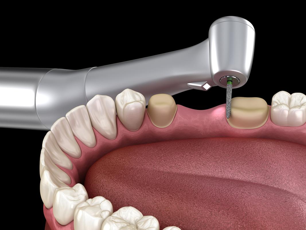 牙博士的种牙技术稳定吗？-图2