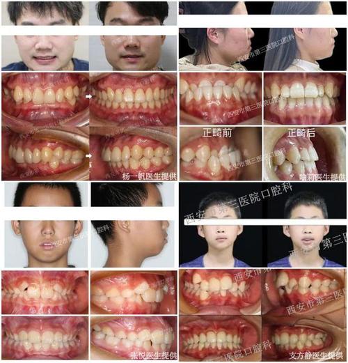 正畸中线为何越来越歪？是正常现象还是需调整？-图1
