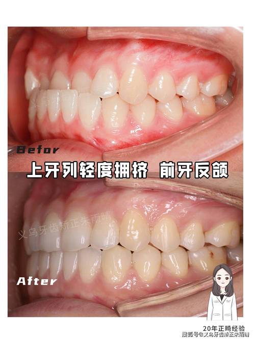 正畸中线为何越来越歪？是正常现象还是需调整？-图2