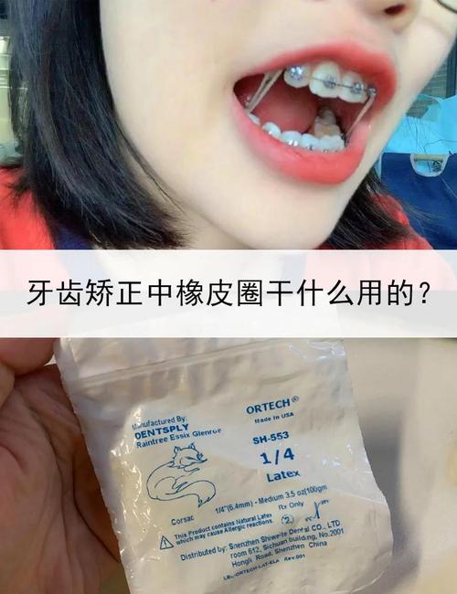 正畸橡皮圈怎么挂最简单?新手一看就会的技巧!-图3 正畸橡皮圈怎么挂最简单?新手一看就会的技巧!-图3