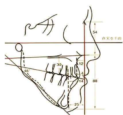 正畸治疗中高角与低角如何区分？治疗策略有何不同？-图3