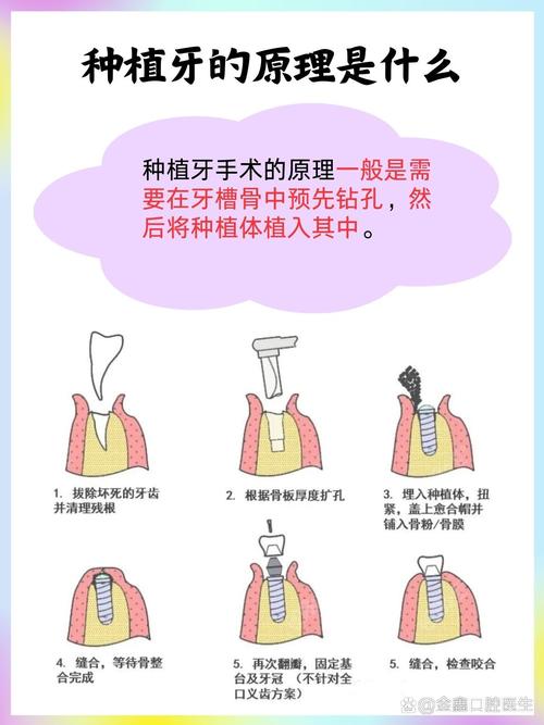种植牙生物膜固定方法的选择标准、操作步骤及注意事项有哪些?-图3 种植牙生物膜固定方法的选择标准、操作步骤及注意事项有哪些?-图3