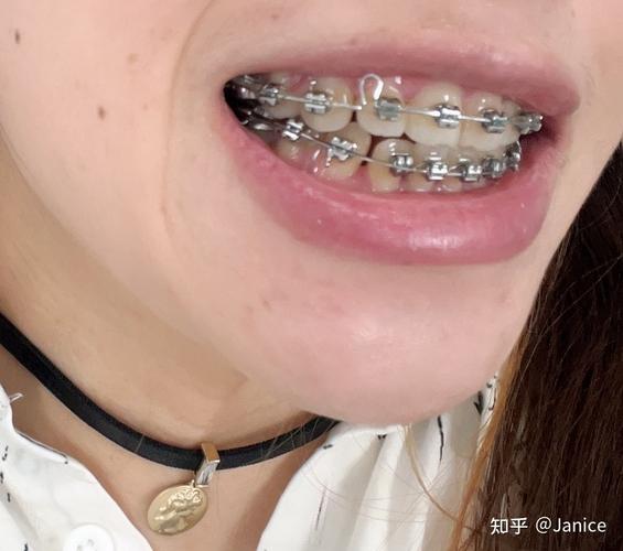 南京市口腔医院正畸效果怎么样？真实案例与效果评价如何？-图1