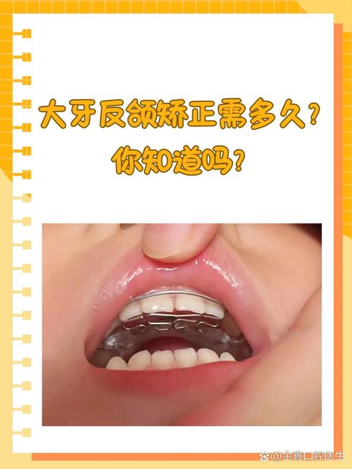 个别牙反颌的解决方法有哪些?-图2 个别牙反颌的解决方法有哪些?-图2