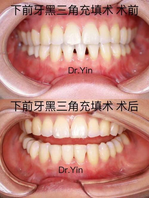 黑三角存在时，正畸可行吗？效果如何？-图2
