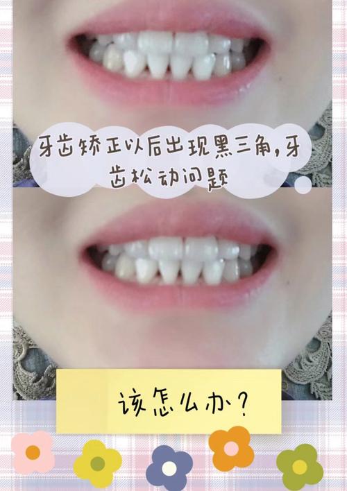 黑三角存在时，正畸可行吗？效果如何？-图1