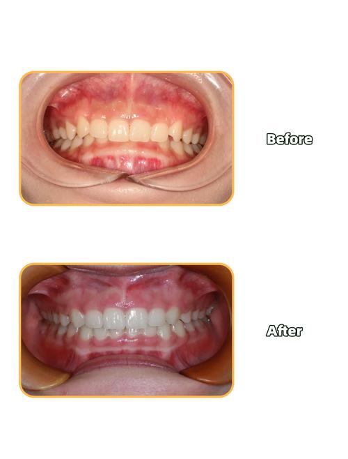 深覆合能自行矫正吗？有哪些安全有效的方法？-图2