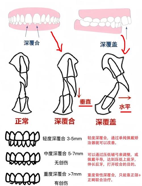 深覆合能自行矫正吗？有哪些安全有效的方法？-图3