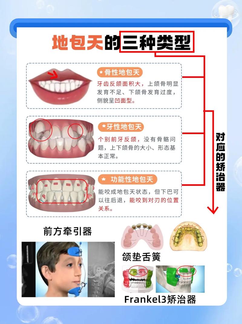 骨性错颌畸形矫治方法有哪些？如何选择最佳矫治方案？-图3