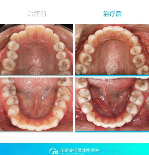 骨性错颌畸形矫治方法有哪些？如何选择最佳矫治方案？-图2