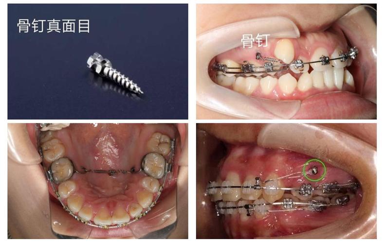 正畸微螺丝钉有何作用？-图2