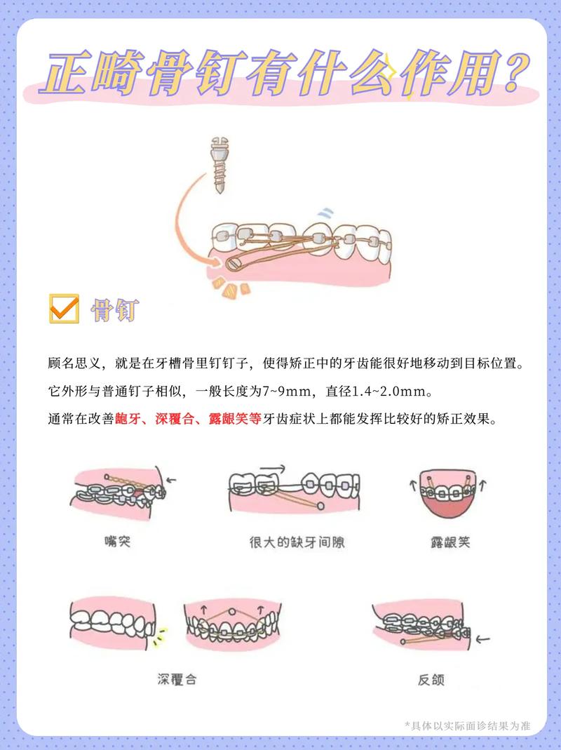 正畸微螺丝钉有何作用？-图1