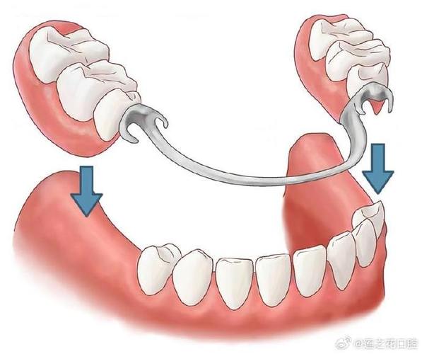 全口假牙固位不足怎么办？有哪些加强固位的实用方法？-图2