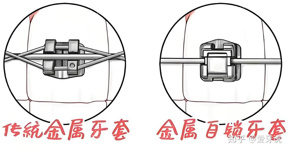普特自锁托槽的使用方法具体有哪些操作步骤和注意事项？-图2