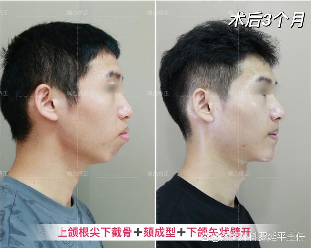 正颌正畸与口腔颌面外科，有何区别与关联？-图3