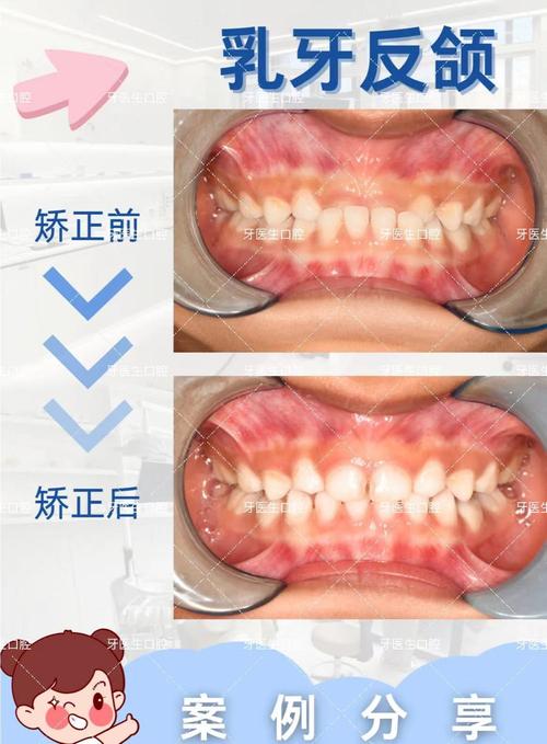错颌畸形矫正方法有哪几种?不同情况如何选?-图1 错颌畸形矫正方法有哪几种?不同情况如何选?-图1