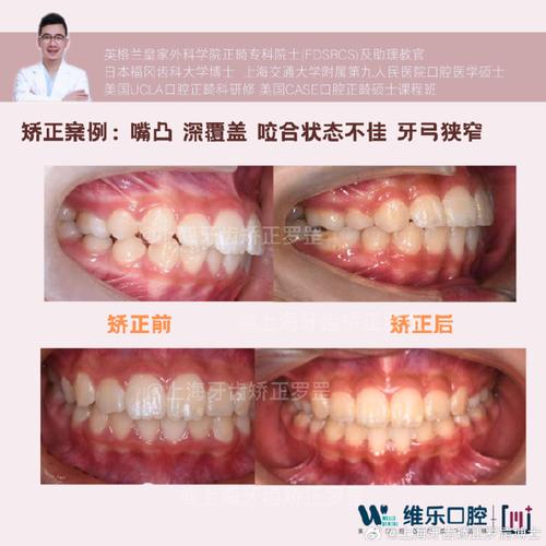 正畸倾斜的牙如何拉正的-图3