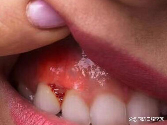 种牙后三天了一直流血，正常吗？该怎么办？-图2