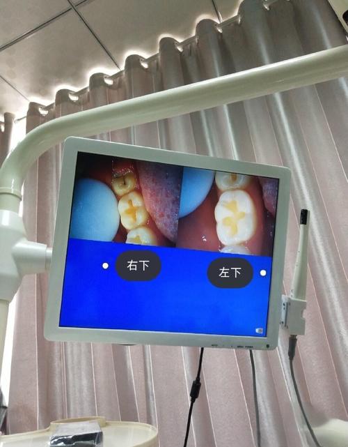 拜博口腔蛀牙怎么治?有哪些注意事项和费用?-图1 拜博口腔蛀牙怎么治?有哪些注意事项和费用?-图1