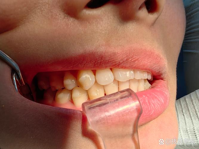 正畸上颚粘的东西是什么？有何作用？-图2