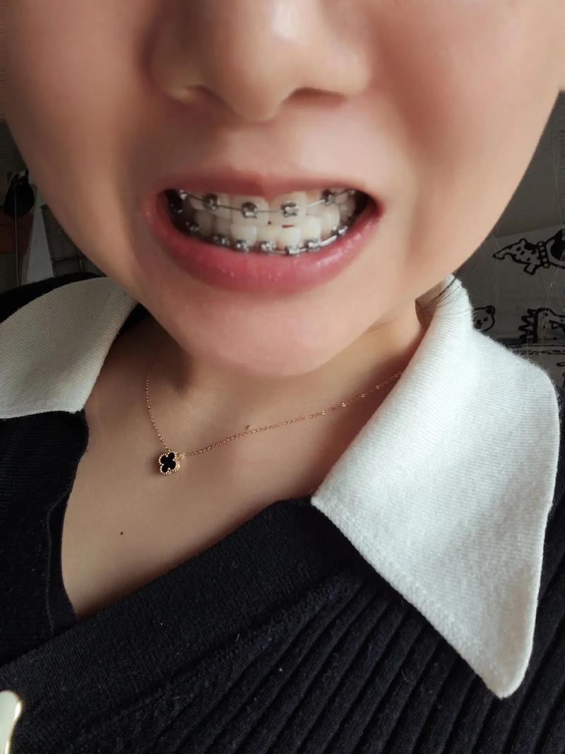 正畸上颚粘的东西是什么？有何作用？-图3