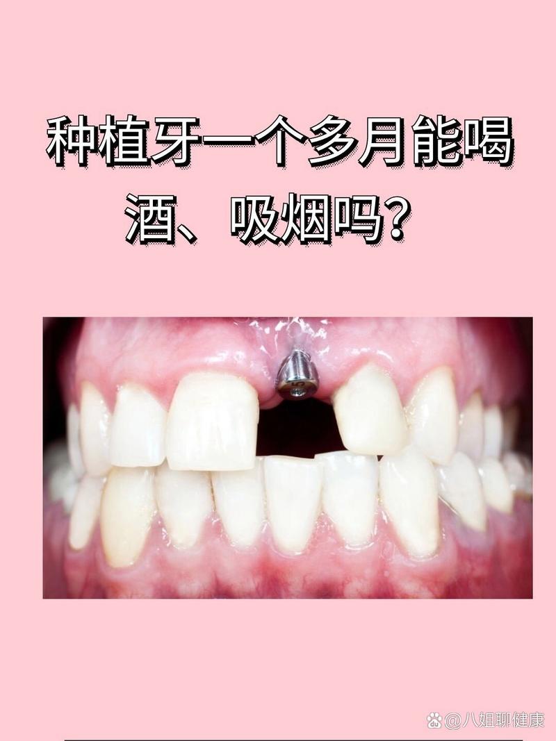 种牙第二天可以喝酒吗-图3 种牙第二天可以喝酒吗-图3