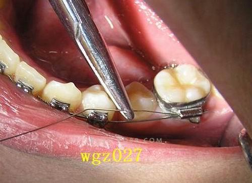 8字结扎法正畸效果如何？操作难点与优势在哪？-图2