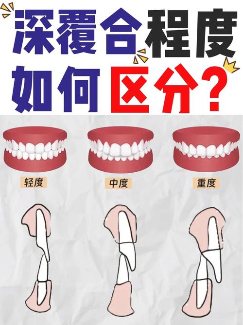确定咬合关系有几种方法-图3 确定咬合关系有几种方法-图3
