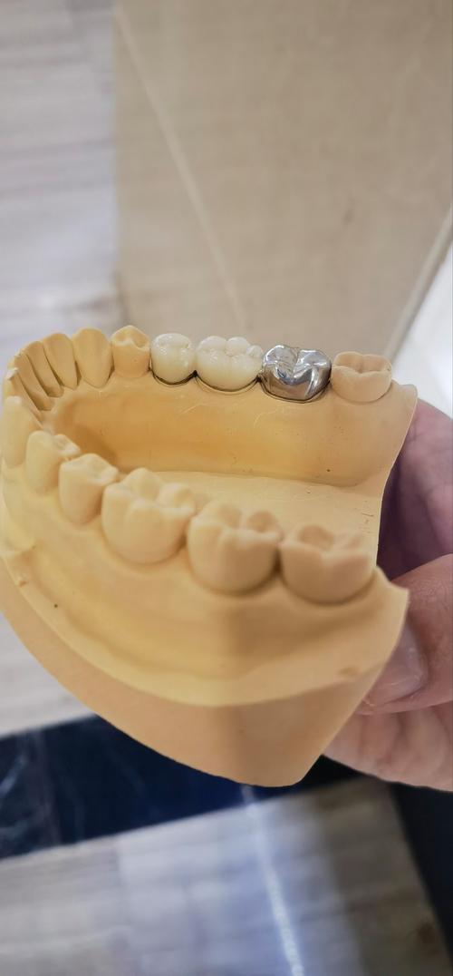 拜博口腔医院假牙安装-图1