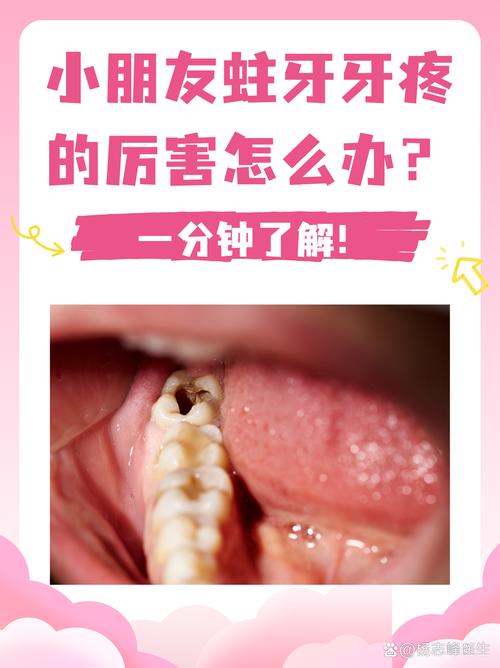 儿童蛀牙疼怎么办？有哪些有效治疗方法？-图2