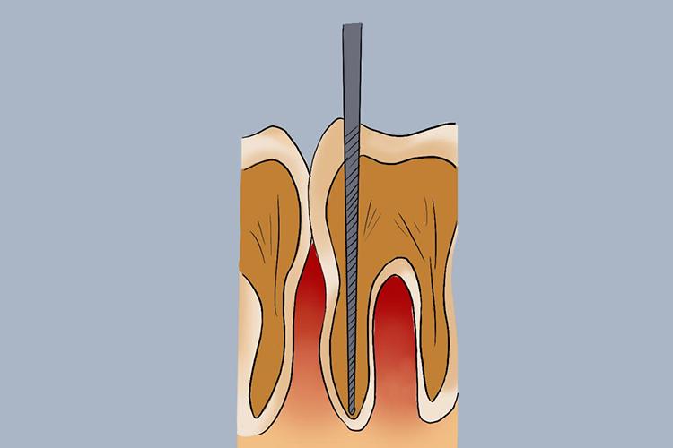 根管测定工作长度的方法-图2
