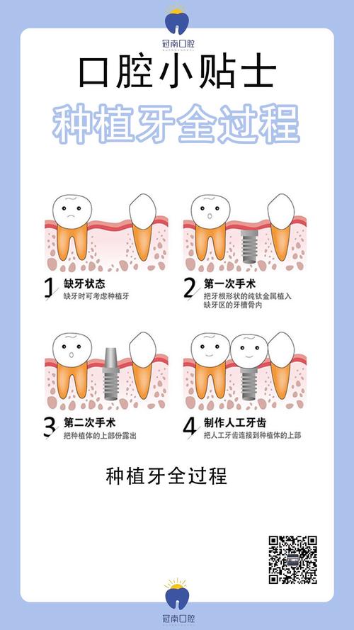 种植牙第二次手术大概需要多长时间完成？-图1