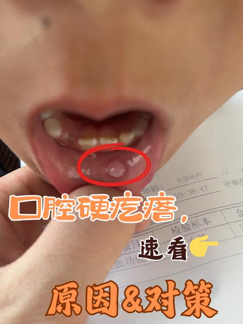 口腔壁增生怎么治？有哪些有效治疗方法？-图1