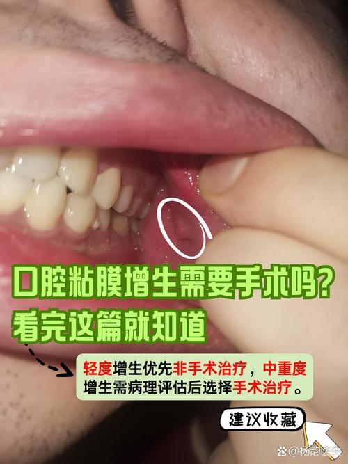 口腔壁增生怎么治？有哪些有效治疗方法？-图2