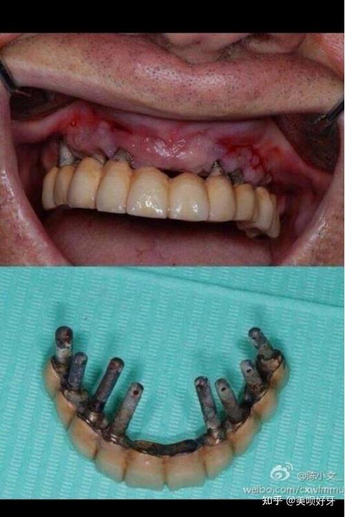 牙种深了会有什么问题吗？-图2