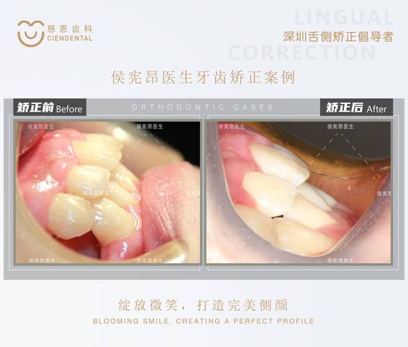 舌侧集中颌排牙方法图片如何直观展示排牙步骤与技巧要点？-图3