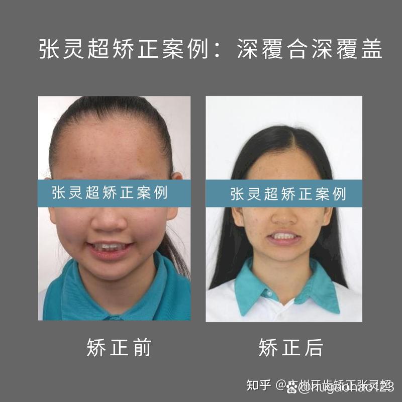 正畸垫高后牙合垫怎么做？具体操作步骤是怎样的？-图3