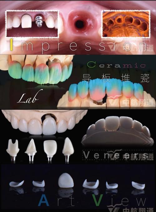 美学修复导板制作方法的关键步骤有哪些？-图2