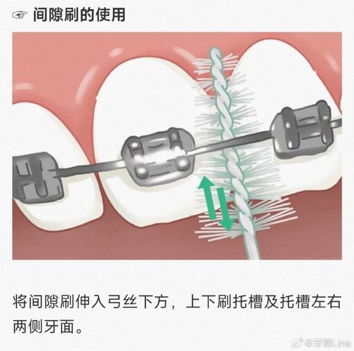 正畸中拉牙齿间隙的方法有哪些步骤和技巧？-图3
