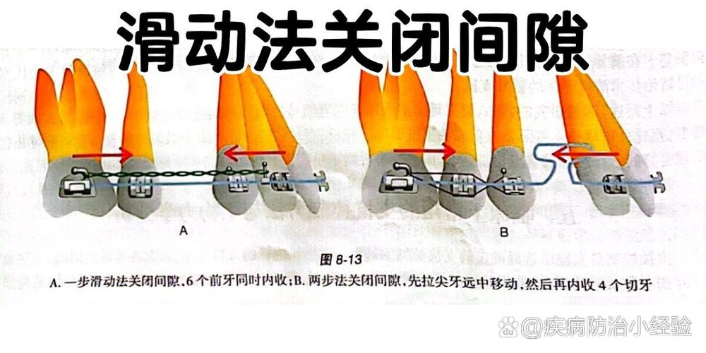 正畸中拉牙齿间隙的方法有哪些步骤和技巧？-图1