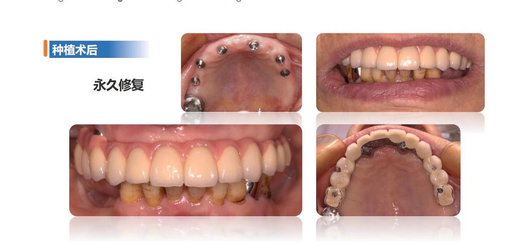 数字化导板种牙精准度如何？临床效果与优势几何？-图2