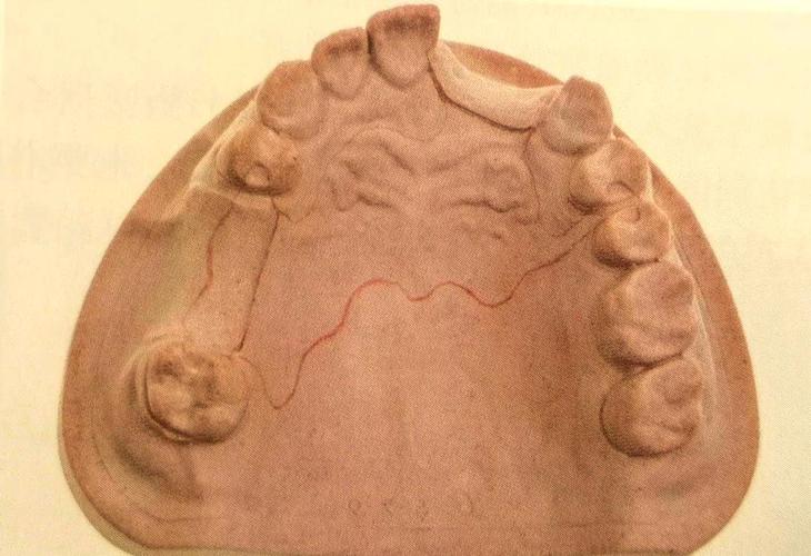 下颌6牙蜡雕刻步骤方法有哪些？详细步骤如何操作？-图3