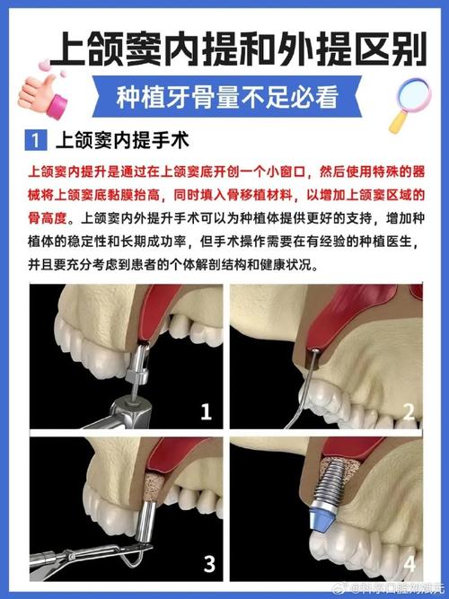 种牙内提和外提的区别究竟是什么？-图1
