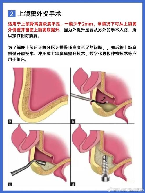 种牙内提和外提的区别究竟是什么？-图2