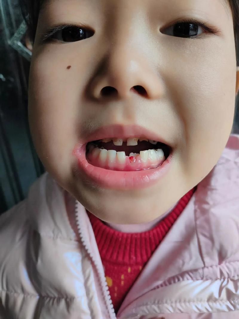 牙齿脱落一年后，还能种牙吗？-图2