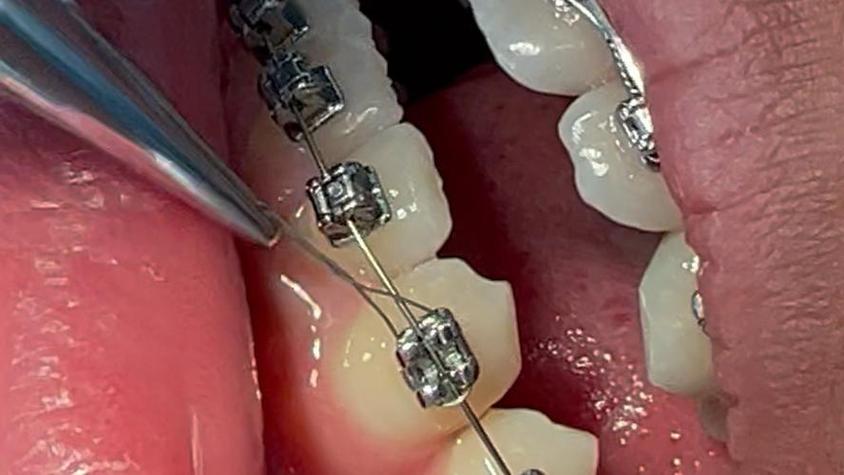 正畸金属自锁最后面钢丝有何关键作用?-图3 正畸金属自锁最后面钢丝有何关键作用?-图3