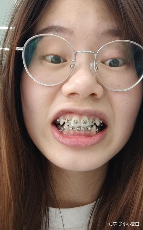 正畸金属自锁最后面钢丝有何关键作用？-图1