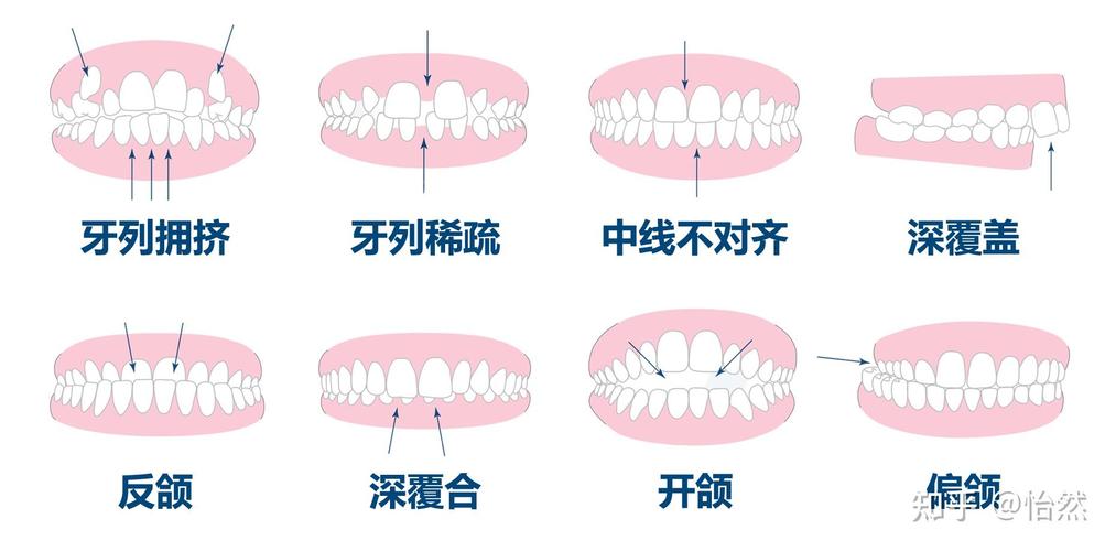 正畸近远中关系具体指什么？-图1